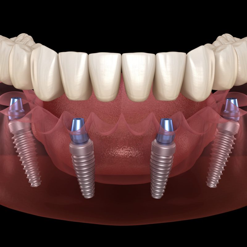 Mandibular,Prosthesis,All,On,4,System,Supported,By,Implants.,Medically
