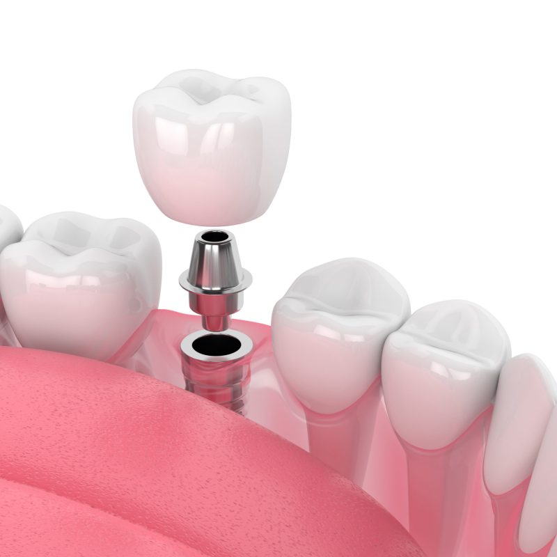 3d,Render,Of,Jaw,With,Dental,Implant,Isolated,Over,White